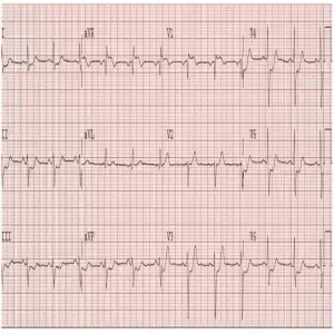 STEMI equiv 3 LMCA-Occlusion